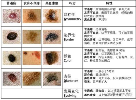 凸起來的痣|我的「痣」會是惡性腫瘤嗎？醫師告訴你：符合這5特。